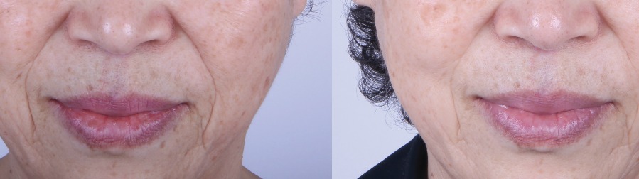 microneedling genosys 1.jpg